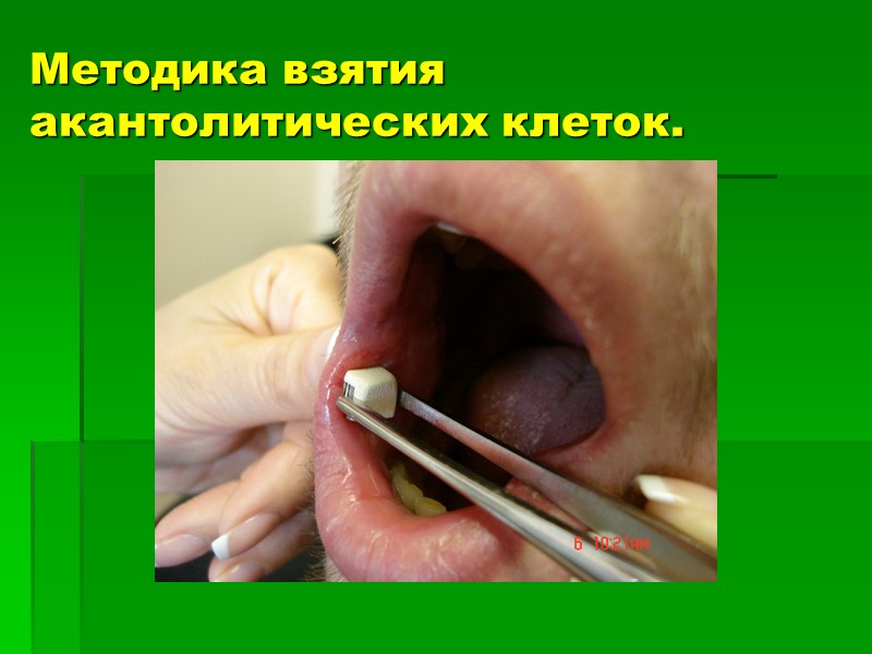 Методика взятия акантолитических клеток.